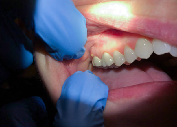 Best Dentist for Tooth Abscess  in Loudoun Lley Estates, VA